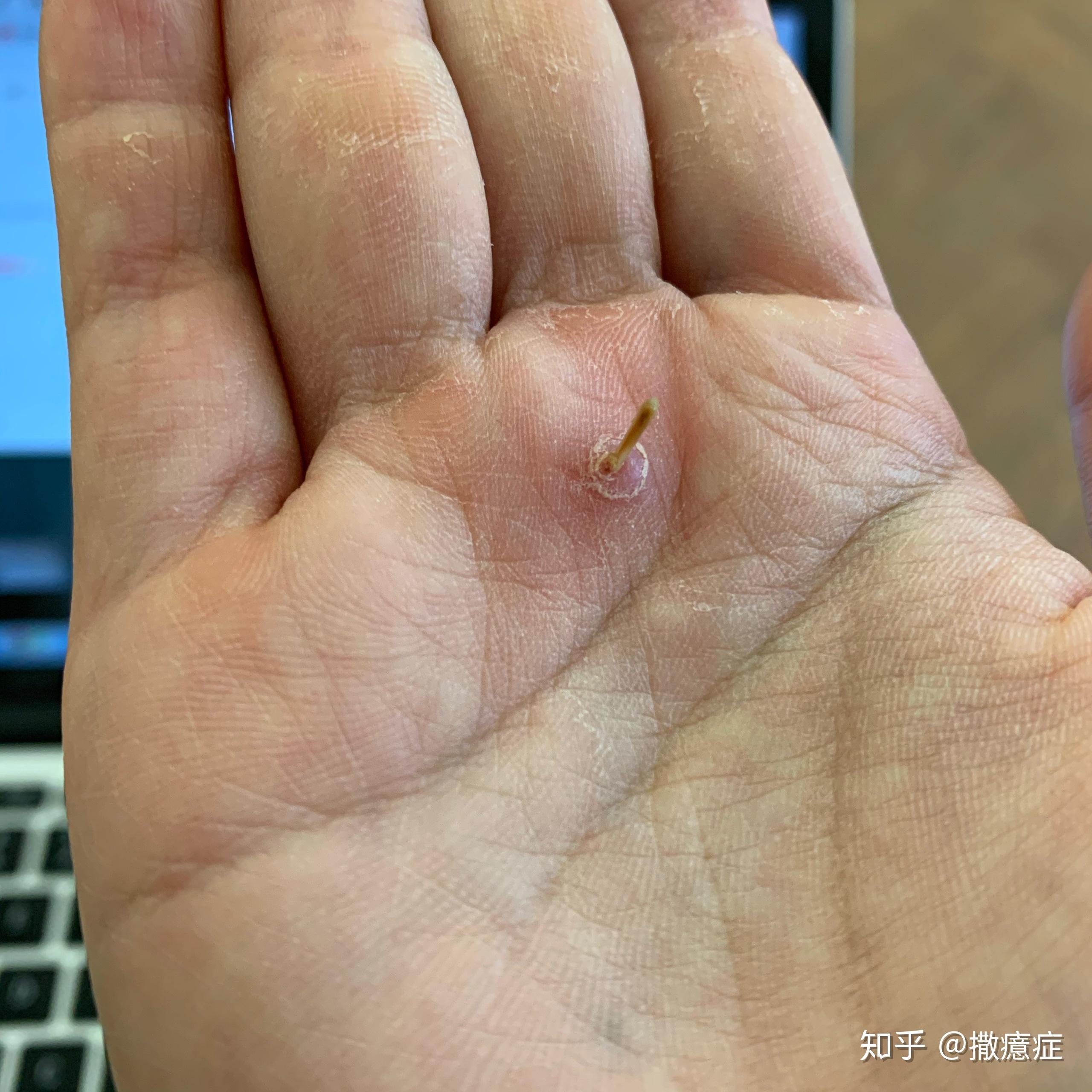 手里扎了刺怎么办? - 知乎