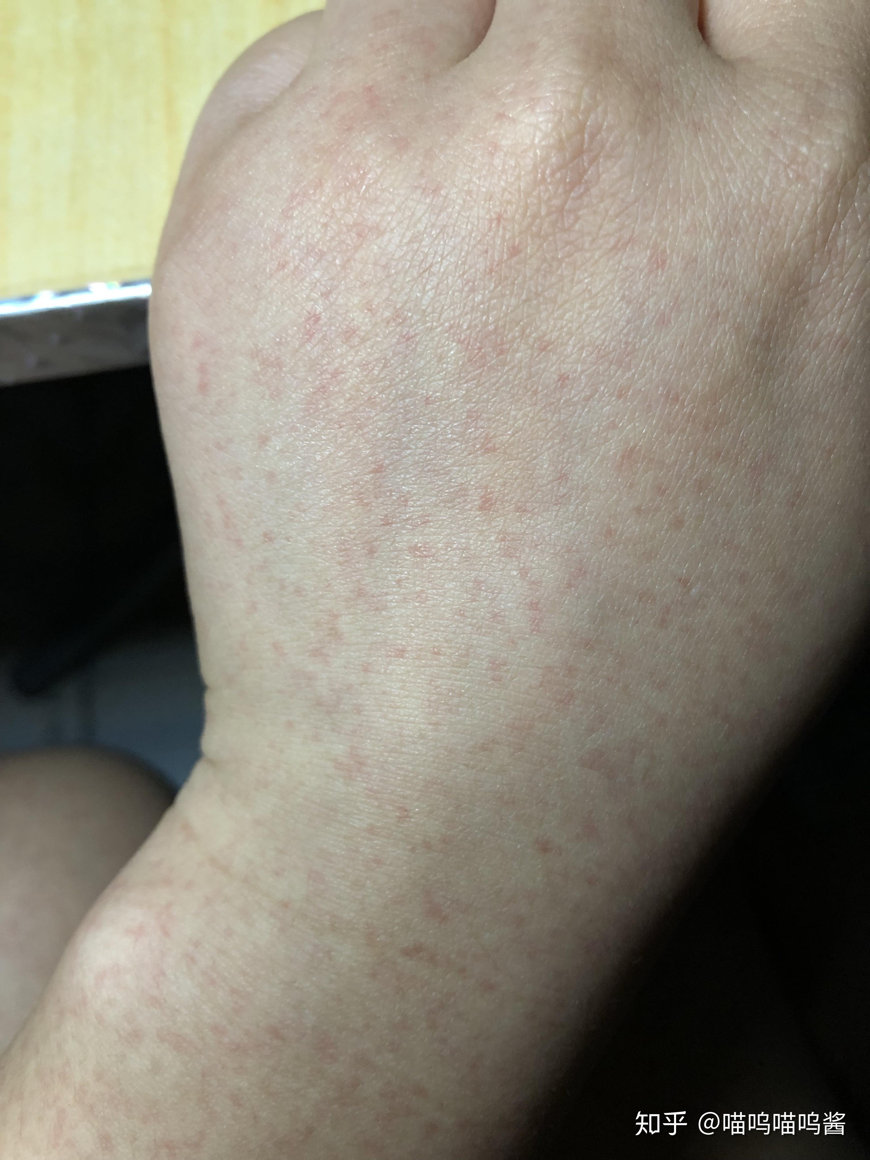 有没有小伙伴和我一样的荨麻疹症状上图