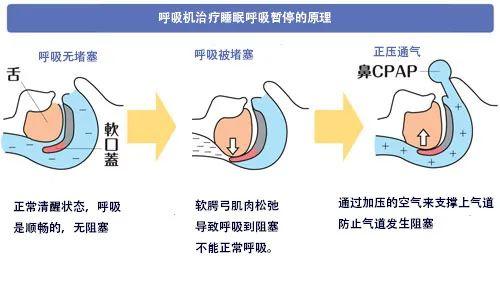 睡觉打鼾，我们要怎么选择正确的家用呼吸机？ - 知乎