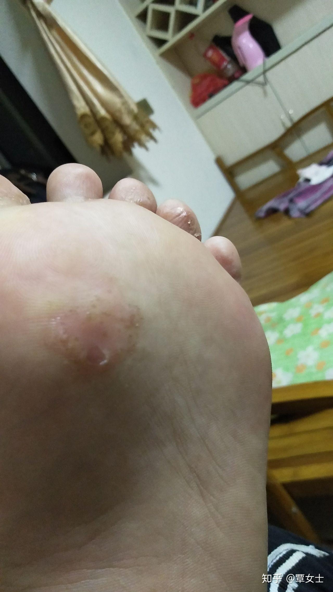 脚掌心长癣且又痒又岀水泡还几年不见好不知是什么病如何治好