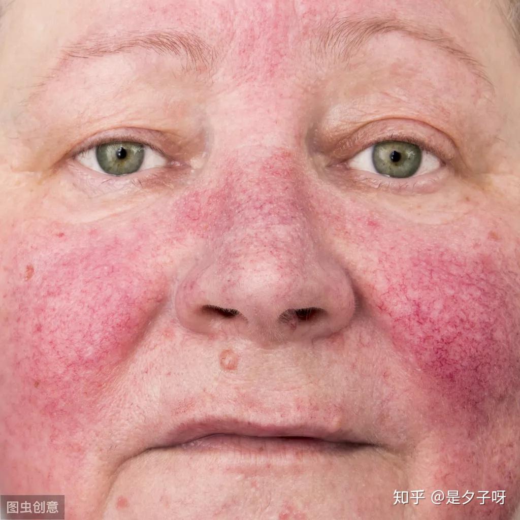 玫瑰痤疮是什么?有哪几个阶段?每个患者都会发展到最严重的阶段吗?