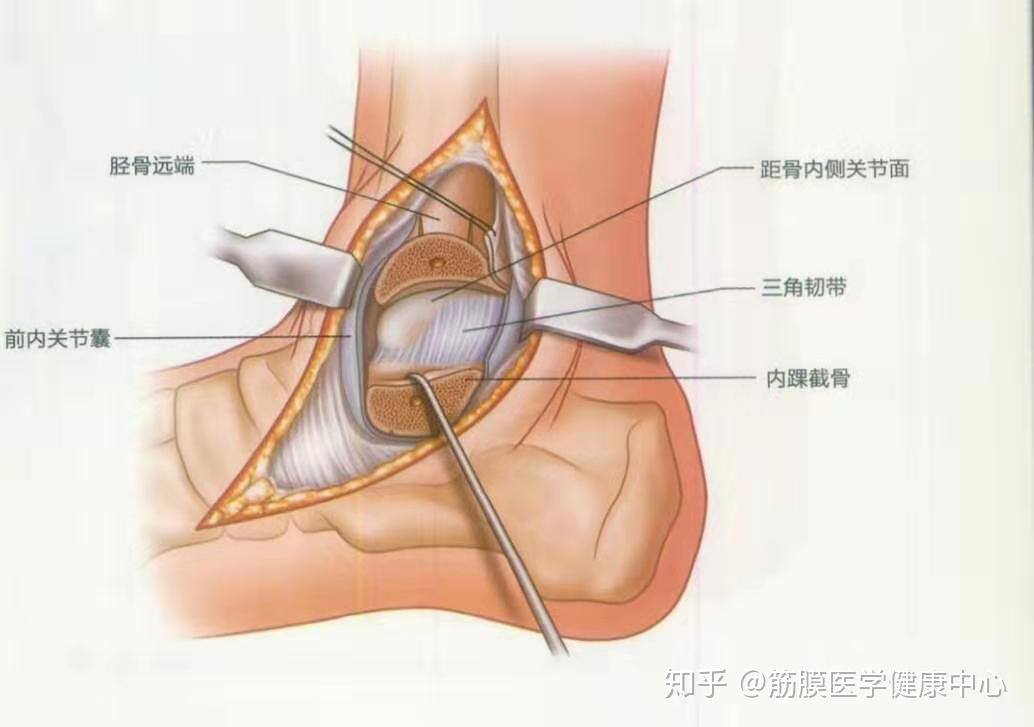 脚踝扭伤,外踝扭伤肿大,为什么内踝疼? - 知乎