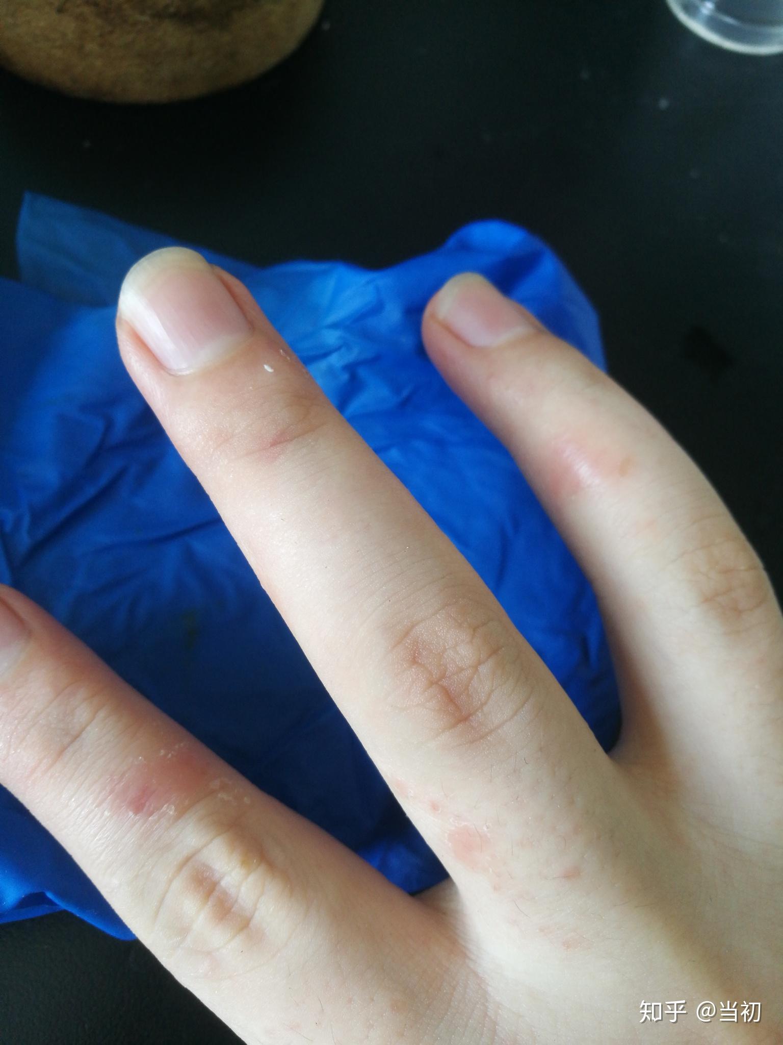 我对蓝色丁腈手套过敏,大家有遇见过类似情况吗?