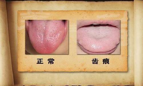 舌头上的齿痕能完全消失吗？ - 知乎