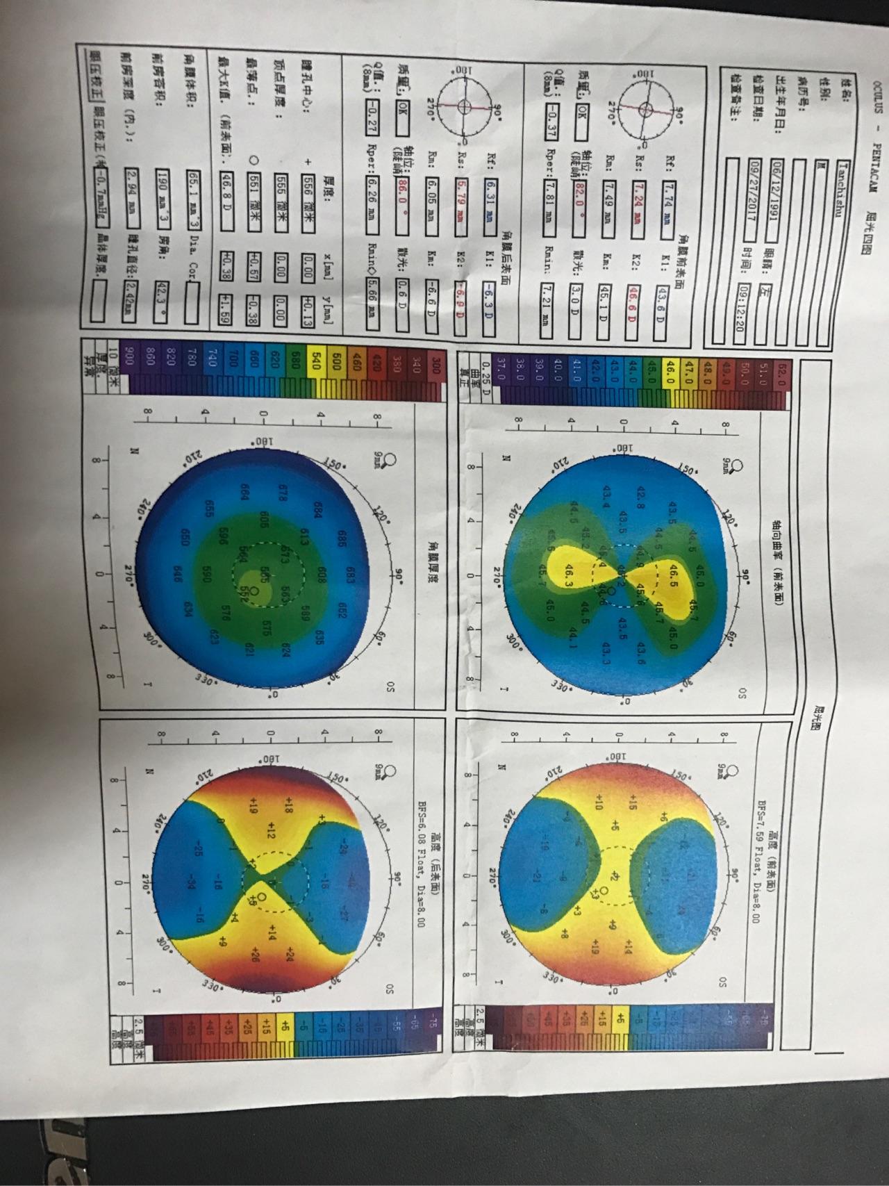 请大神看一下角膜地形图,是不是不规则散光,晚上看东西上下重影?