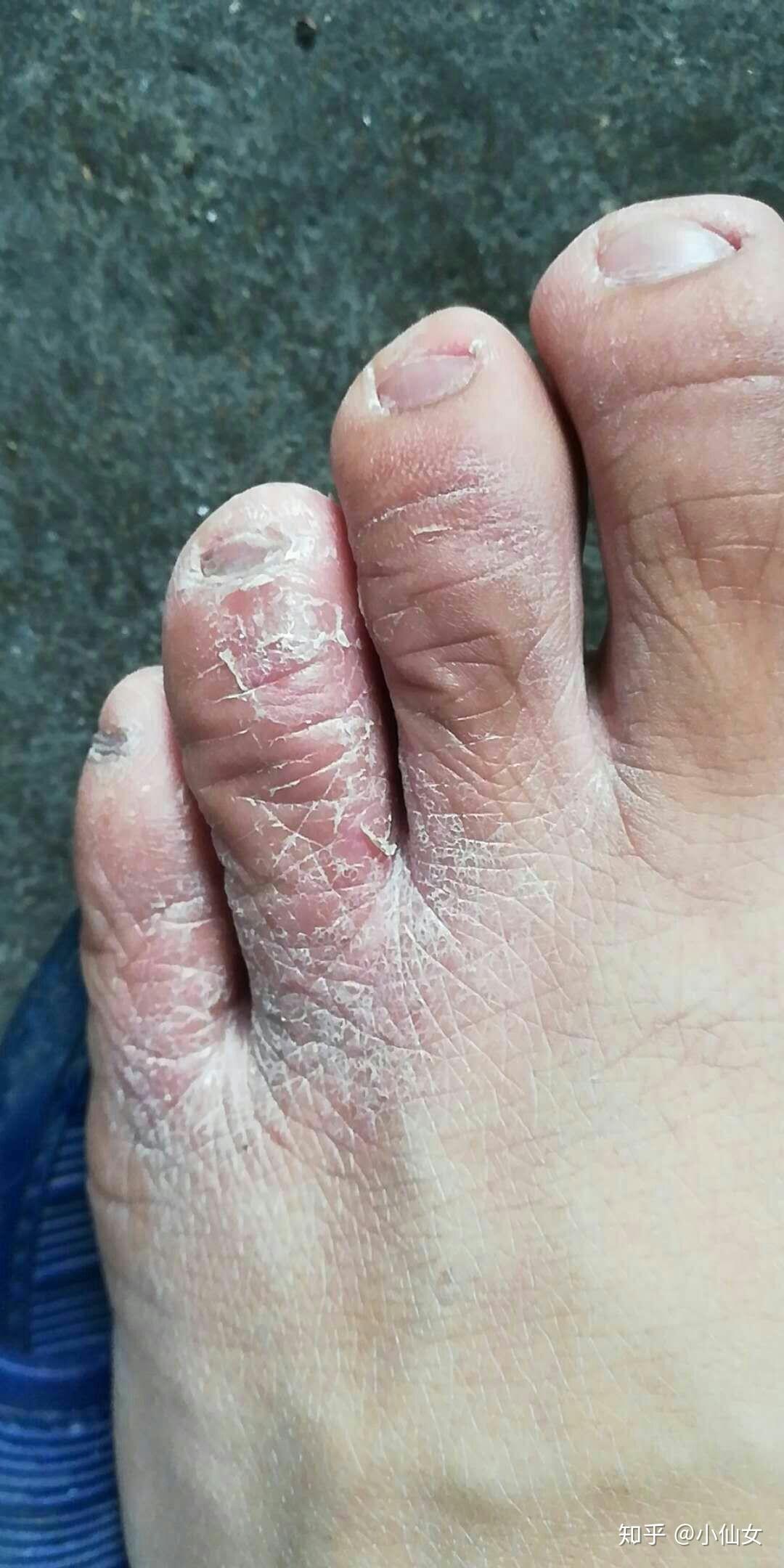 手脚脱皮严重? - 知乎