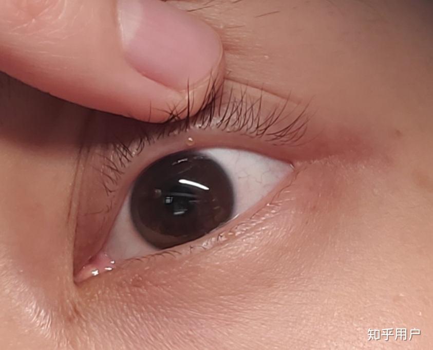 好害怕,觉得眼结石 ,求推荐眼药水?