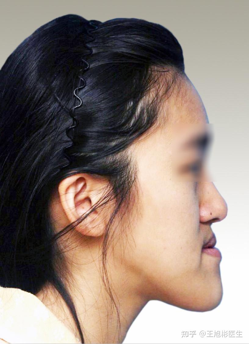 侧脸像一块板 或者有什么医美仪器提拉一下有效果吗?