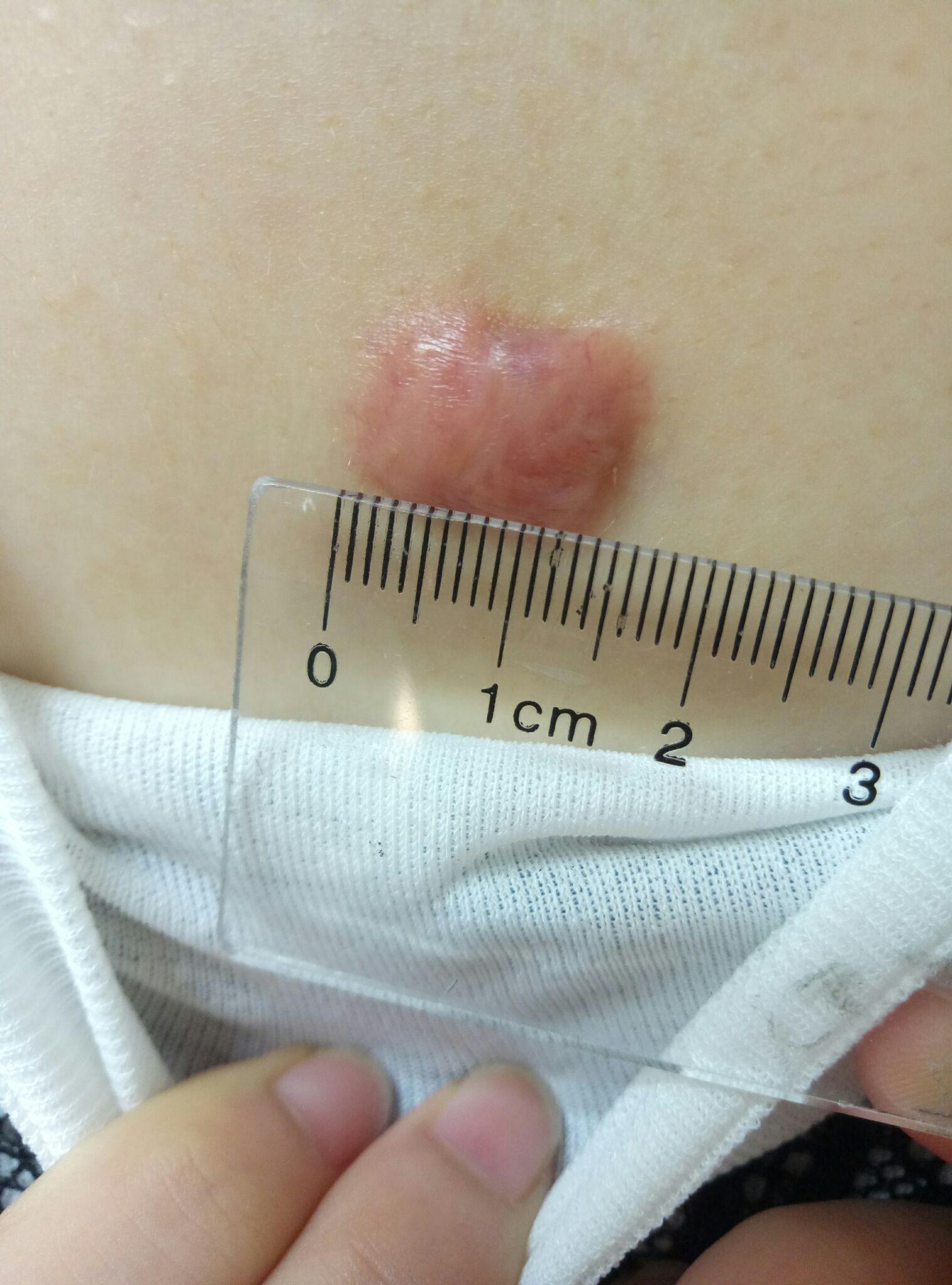 真的有疤痕体质这个东西吗