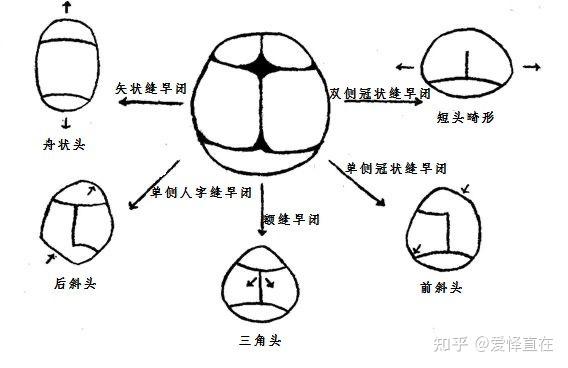 扁頭的危害已經非常普及了那尖頭舟狀頭有什麼危害呢