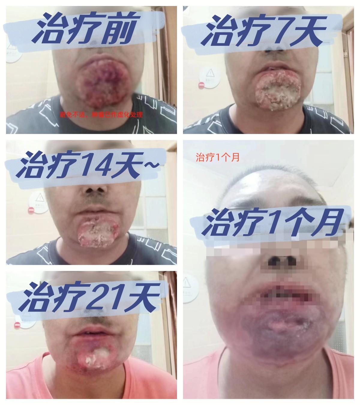 唇癌是什么原因造成的?