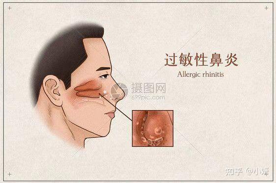 鼻塞的时候鼻子是什么样的?是什么东西堵住的?