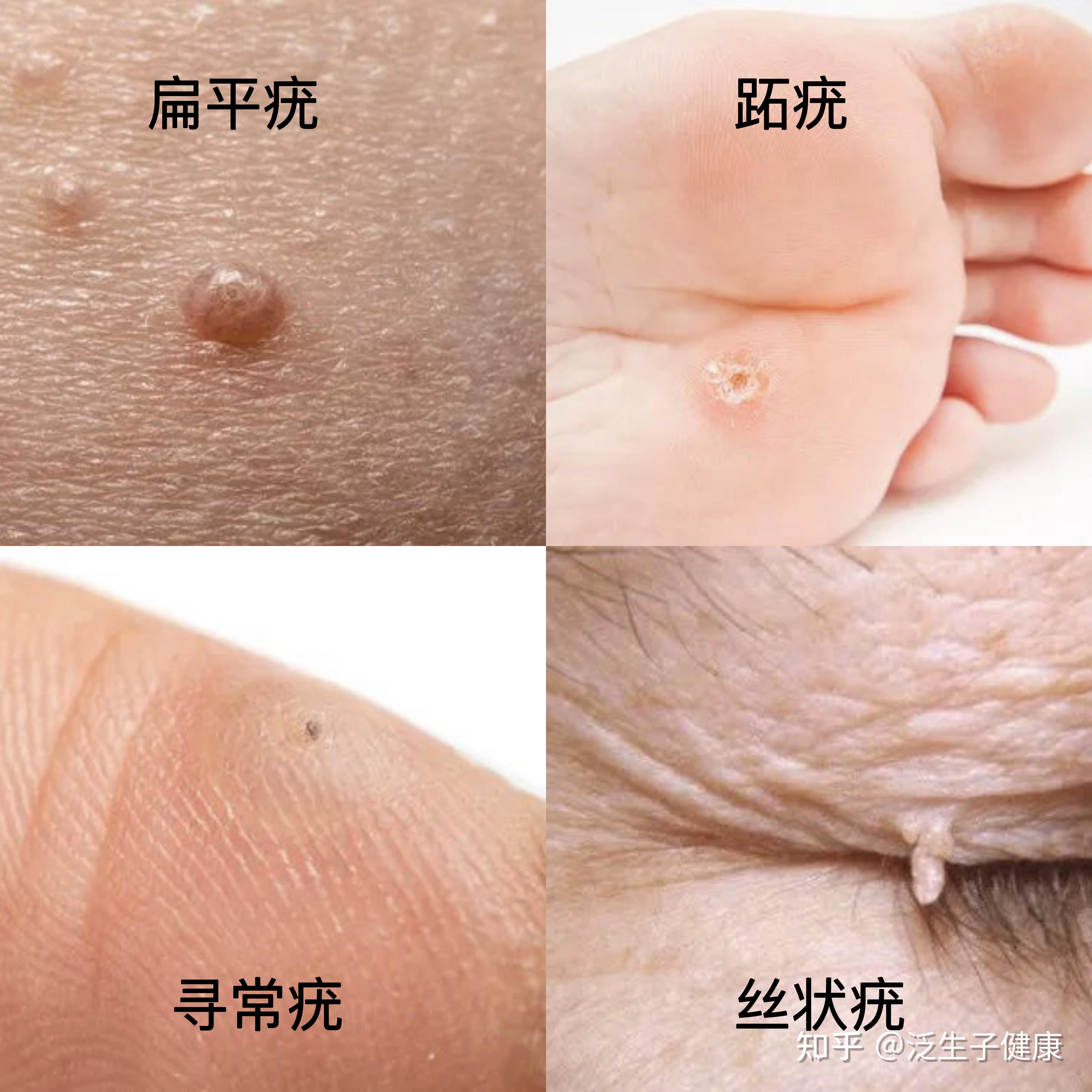 男性hpv什么症状图片