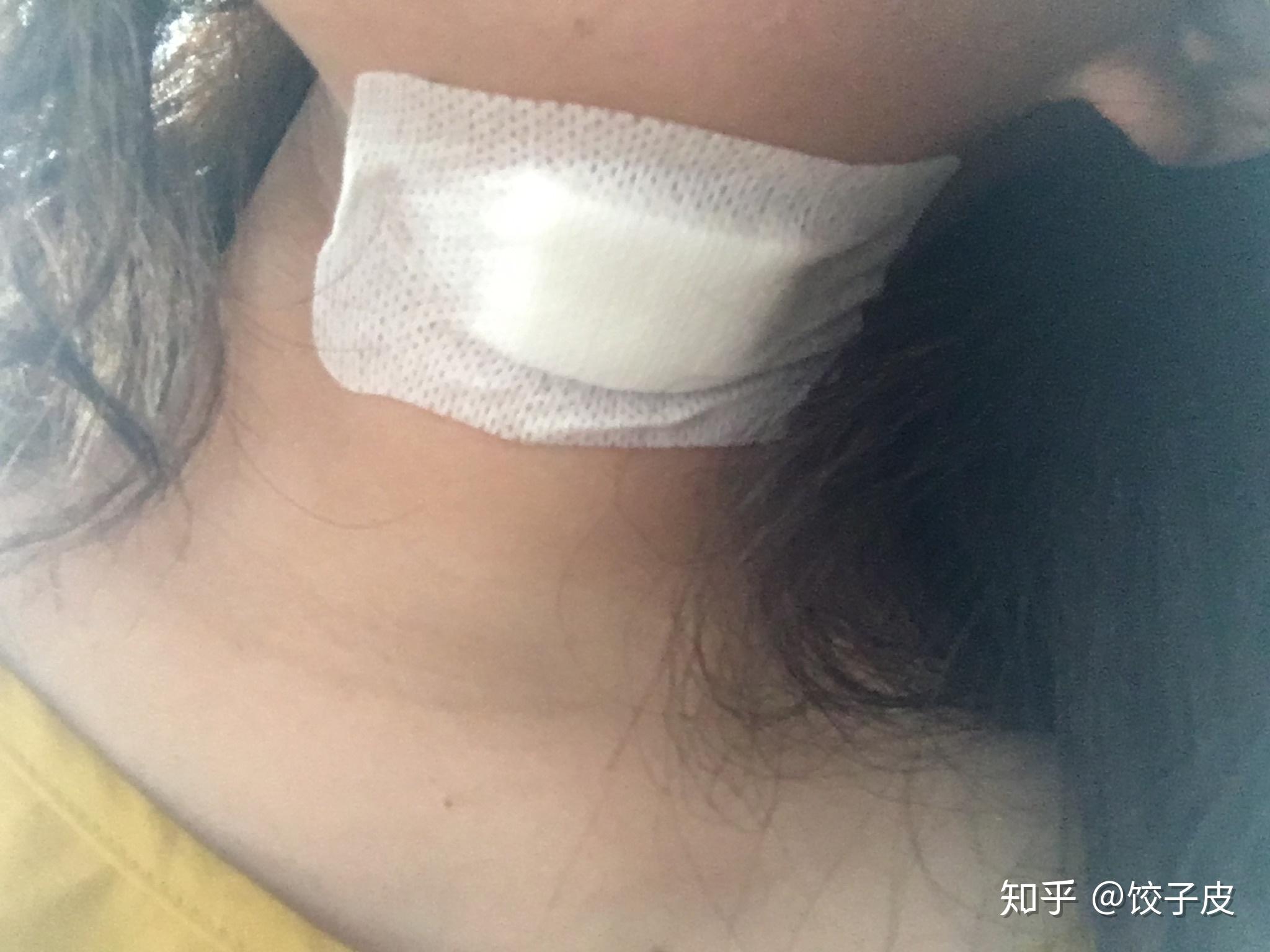 脖子上长了个东西医生说是囊肿但是怎么不用开刀消除呢