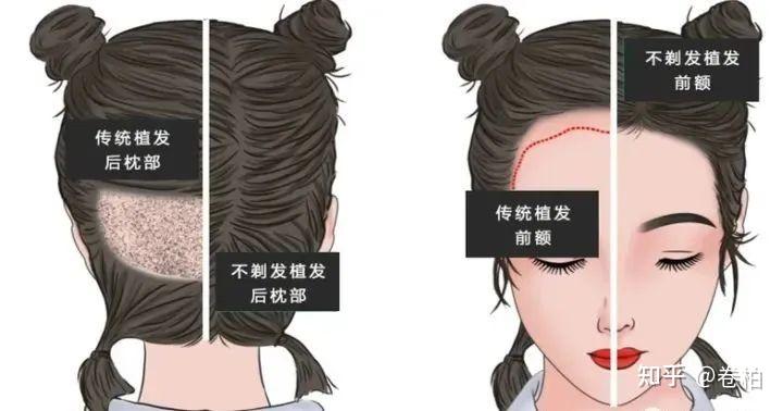 不剃发植发和剃发植发哪个好？ - 知乎