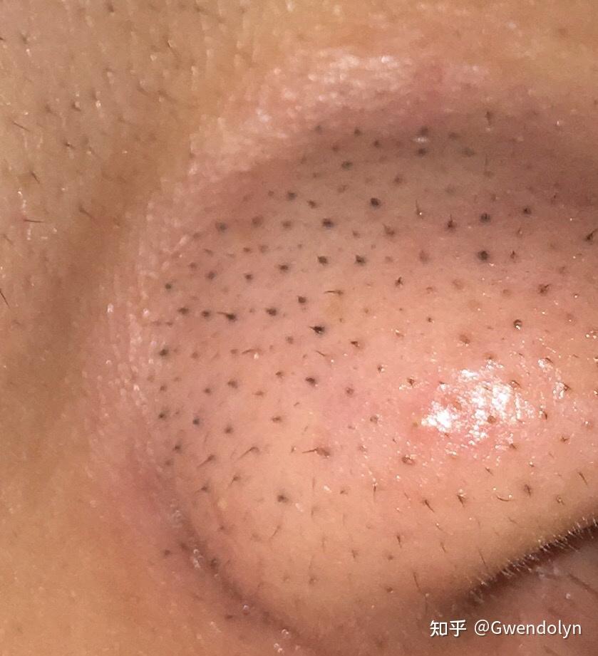 鼻子上长了黑头,里面还有黑色的毛,这是什么类型的黑头,怎么去除? - 知乎