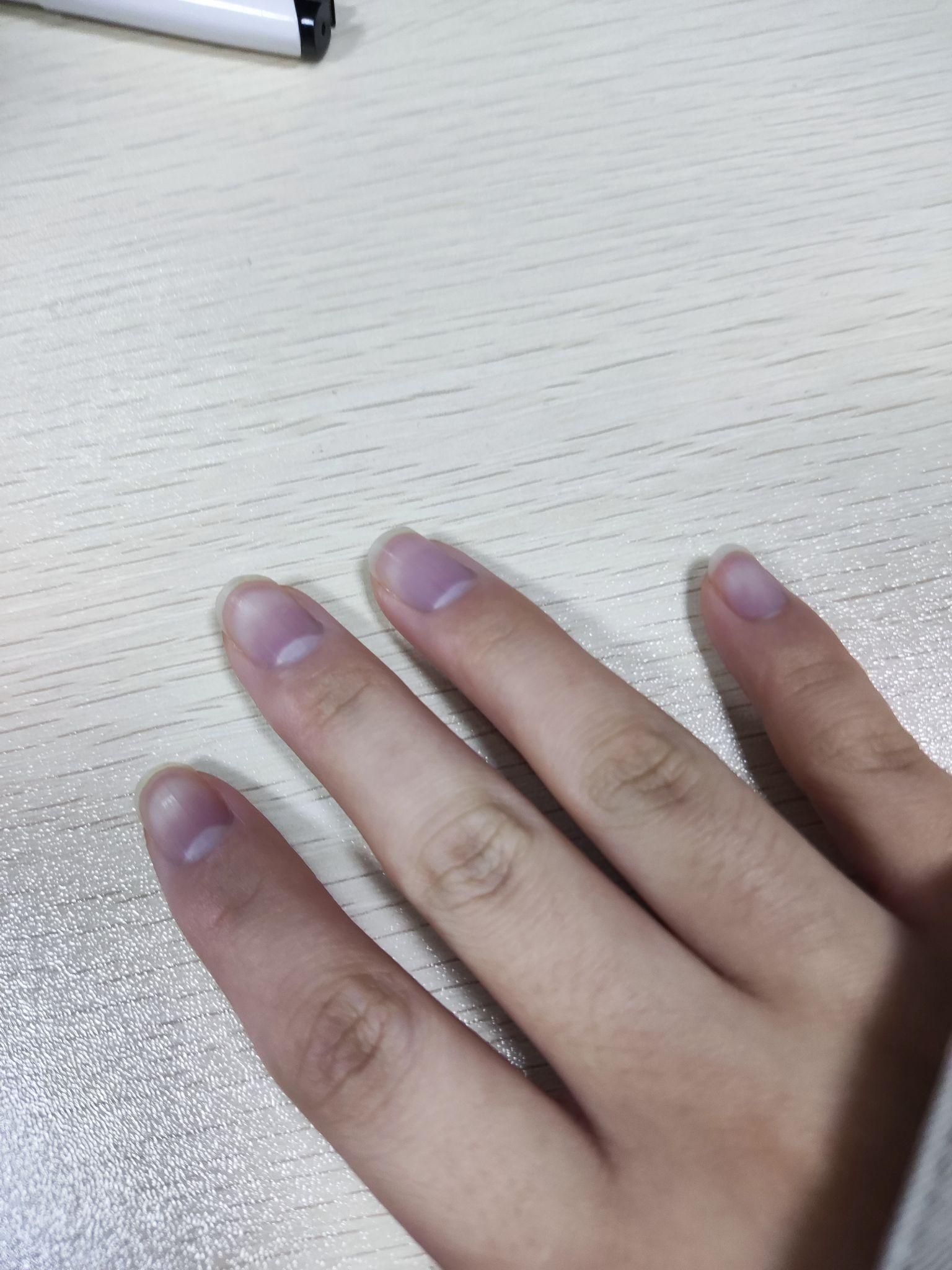 手指甲盖发紫图片