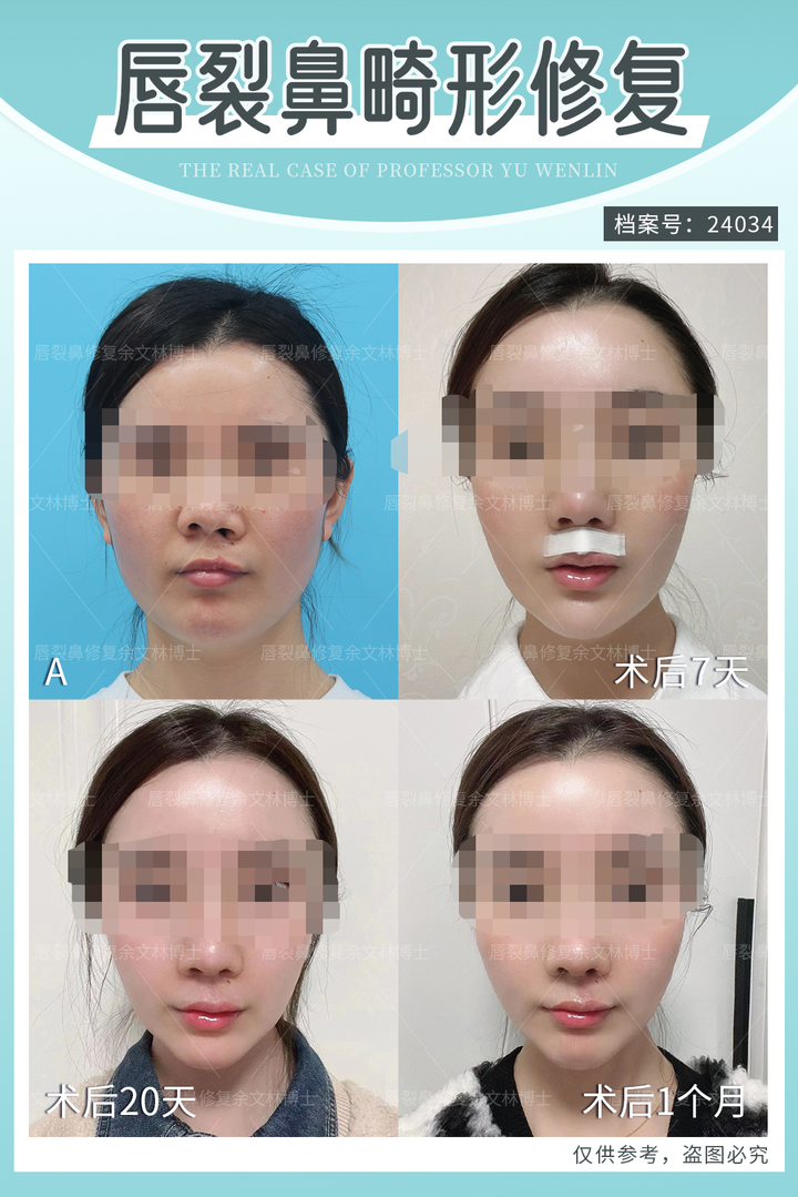 兔唇能修复得看起来和正常人一样吗? - 知乎