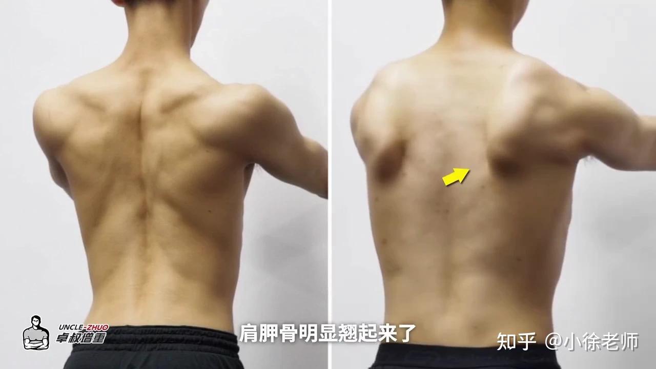 为什么有些人背部脊柱沟凹进去很深，而有的人凸出来很明显？ - 知乎