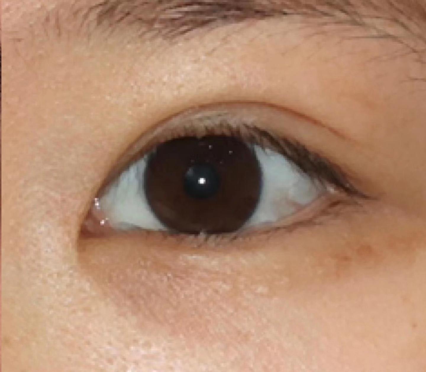 【术前诊断】：眼裂短、眼间距宽、重度内眦赘皮患者，_圈子-新氧美容整形