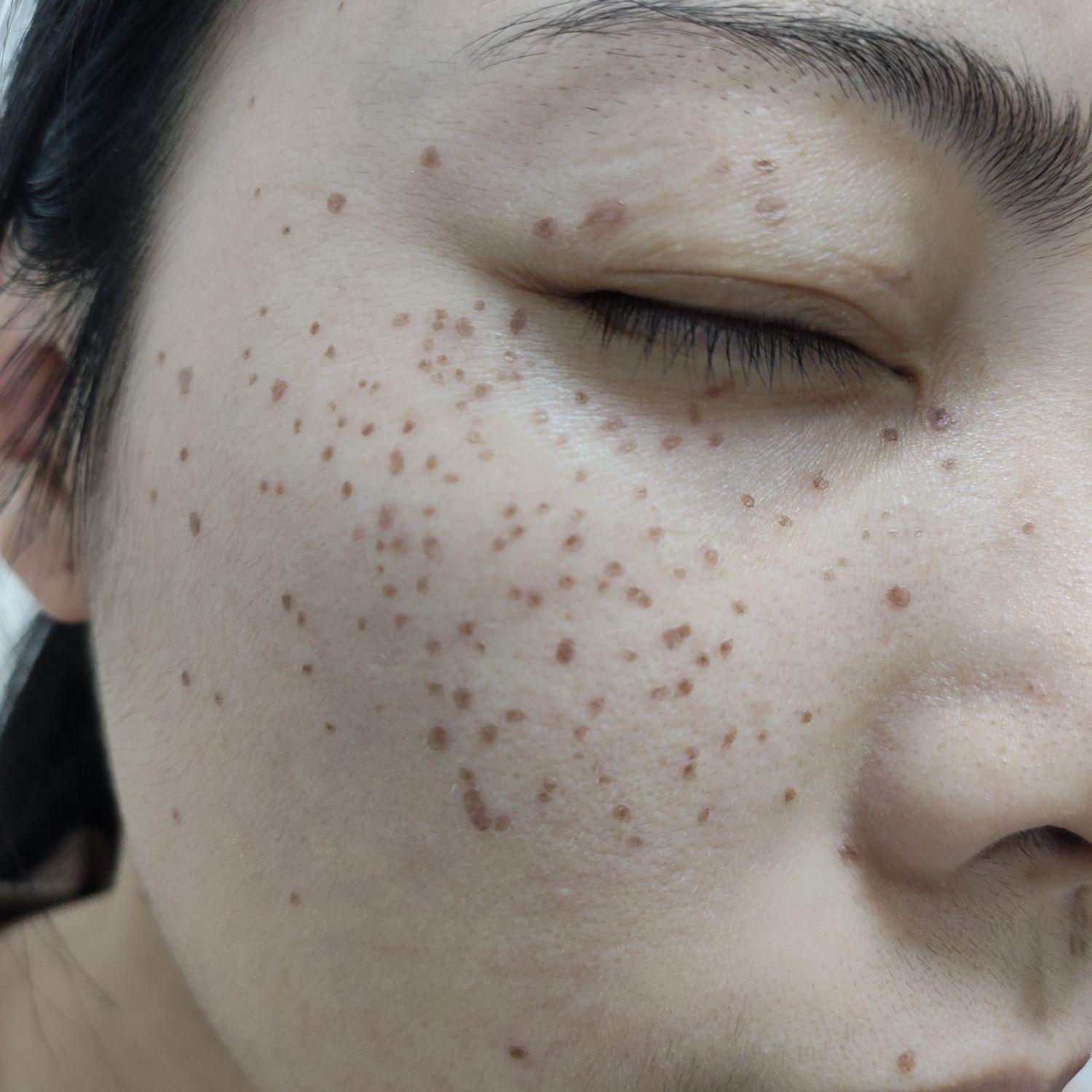 点斑后的恢复期? - 知乎