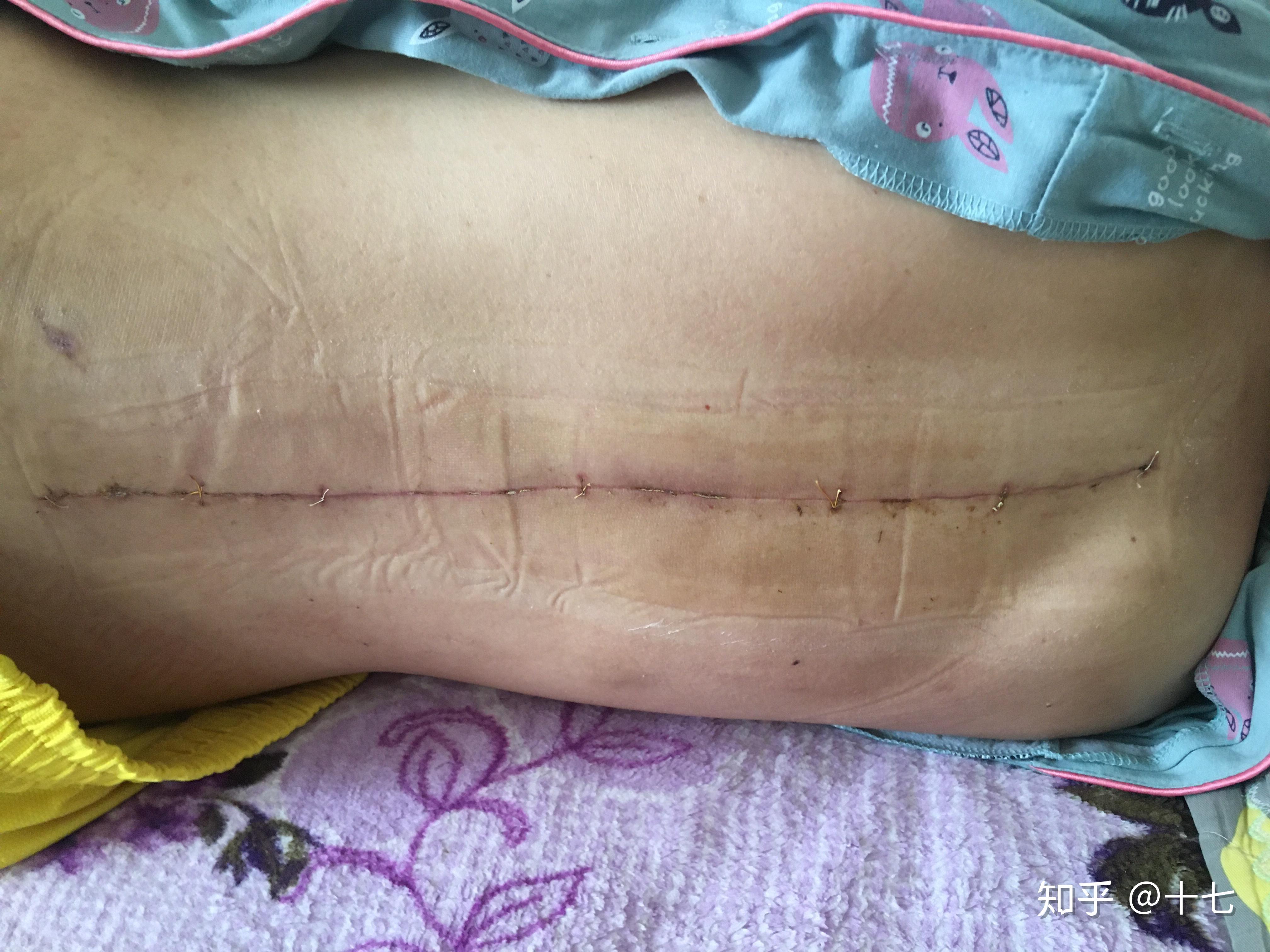 李华脊柱侧弯手术视频(脊柱侧弯手术矫正视频3d演示)