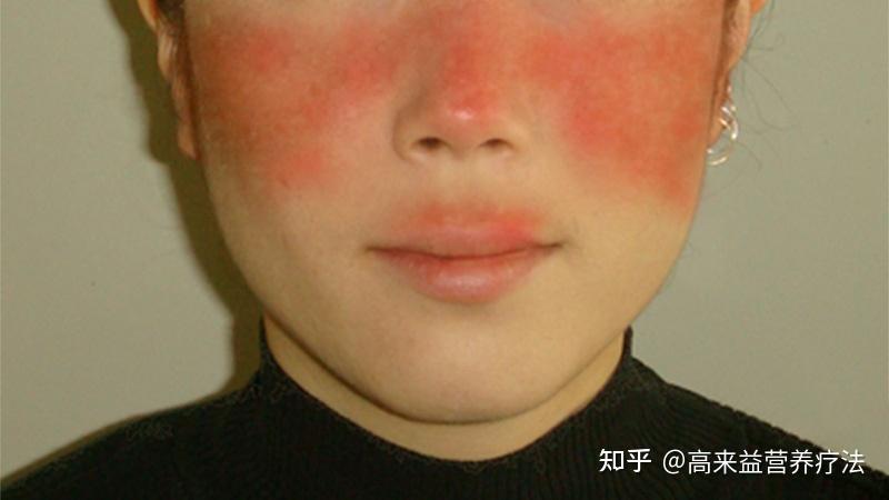为什么大众对红斑狼疮的误解这么深