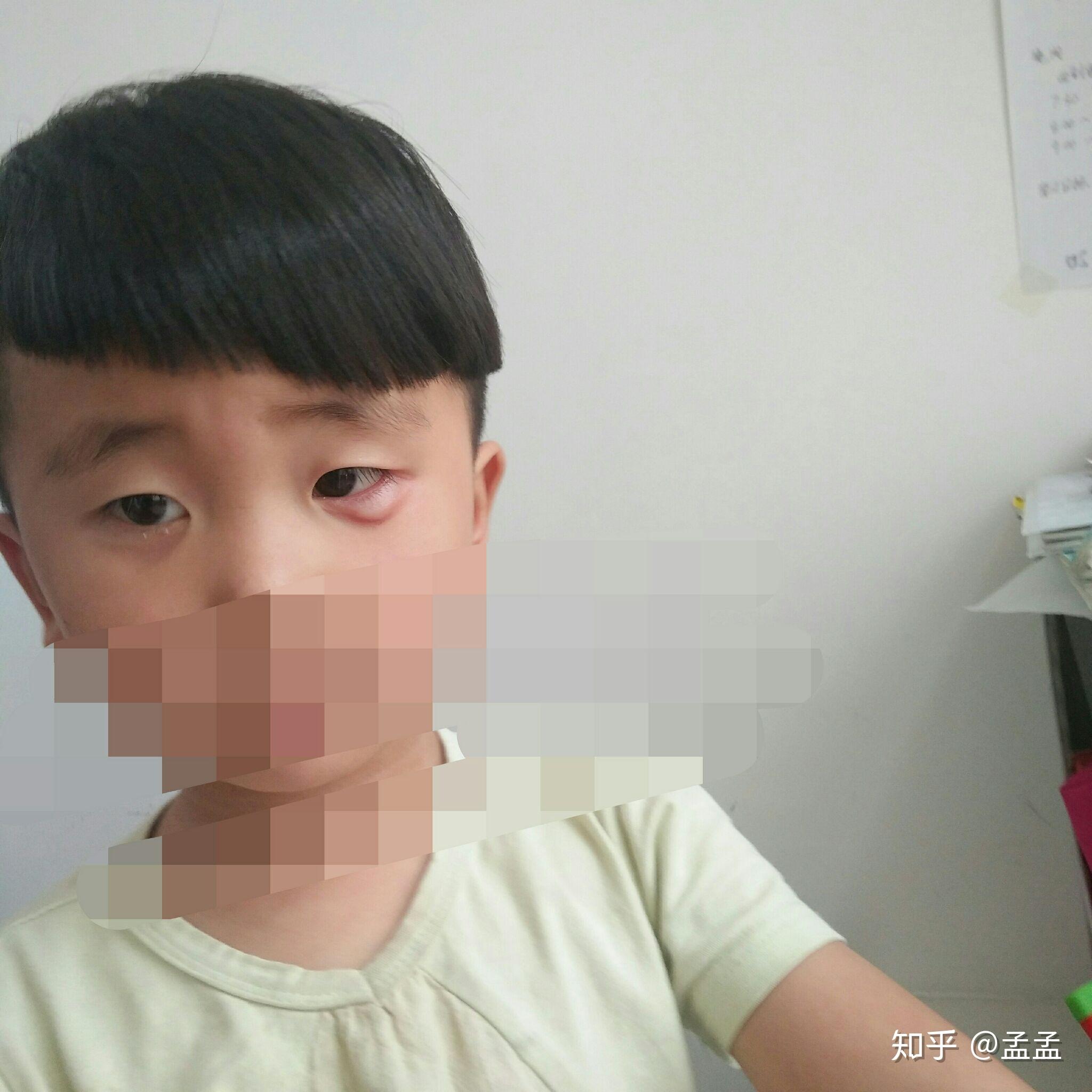 求医,我家宝宝三岁眼睛下眼皮肿了三次相隔时间大概一个月左右,这次最