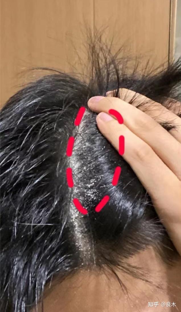 大块大块地掉头皮屑,有什么好用的男士去屑洗发水推荐? - 知乎