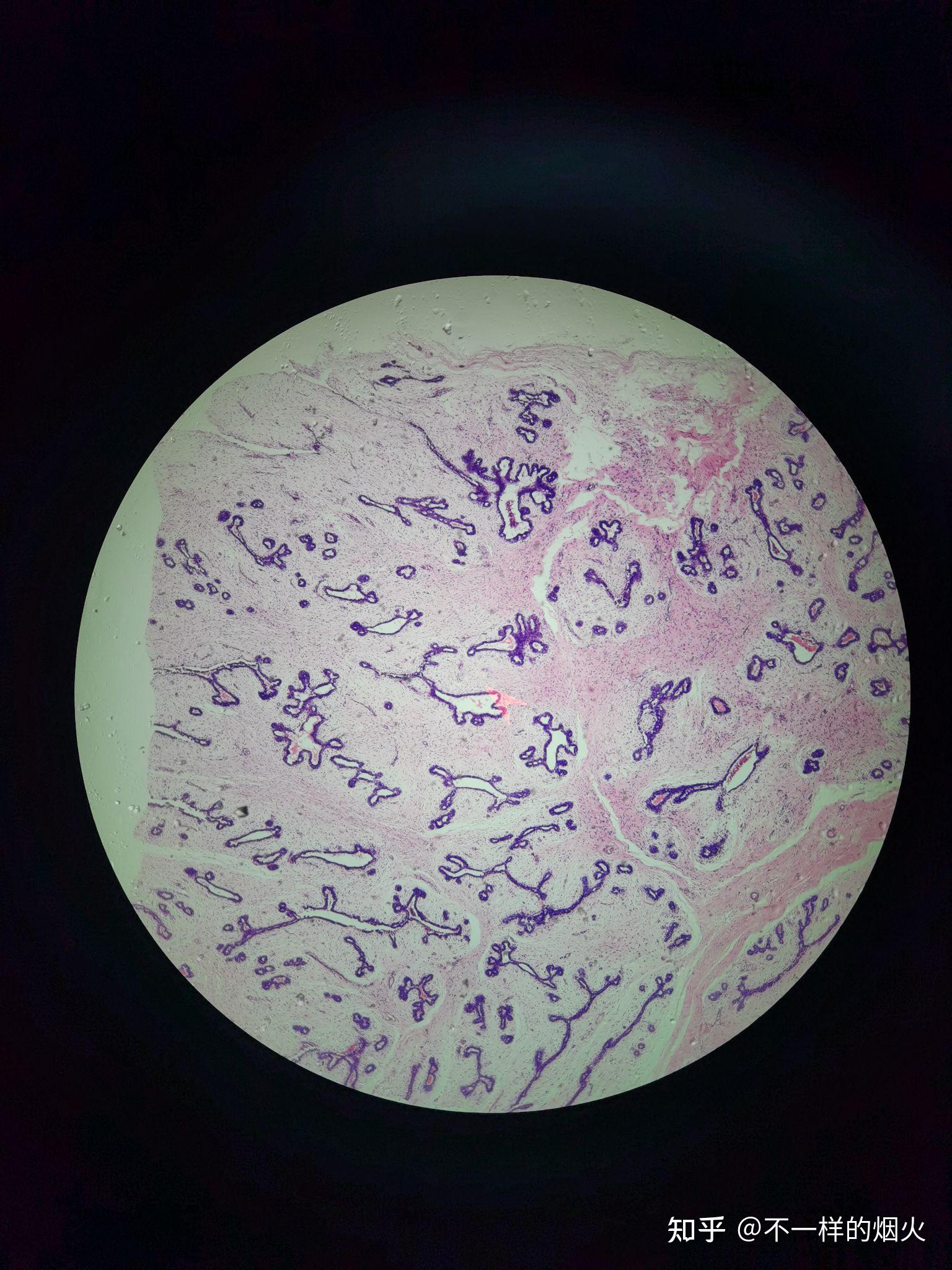 乳腺纤维腺瘤的镜下观?