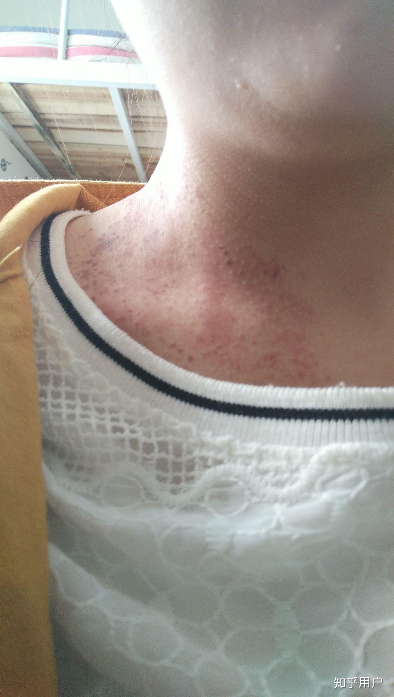 雀斑样痣还有救吗