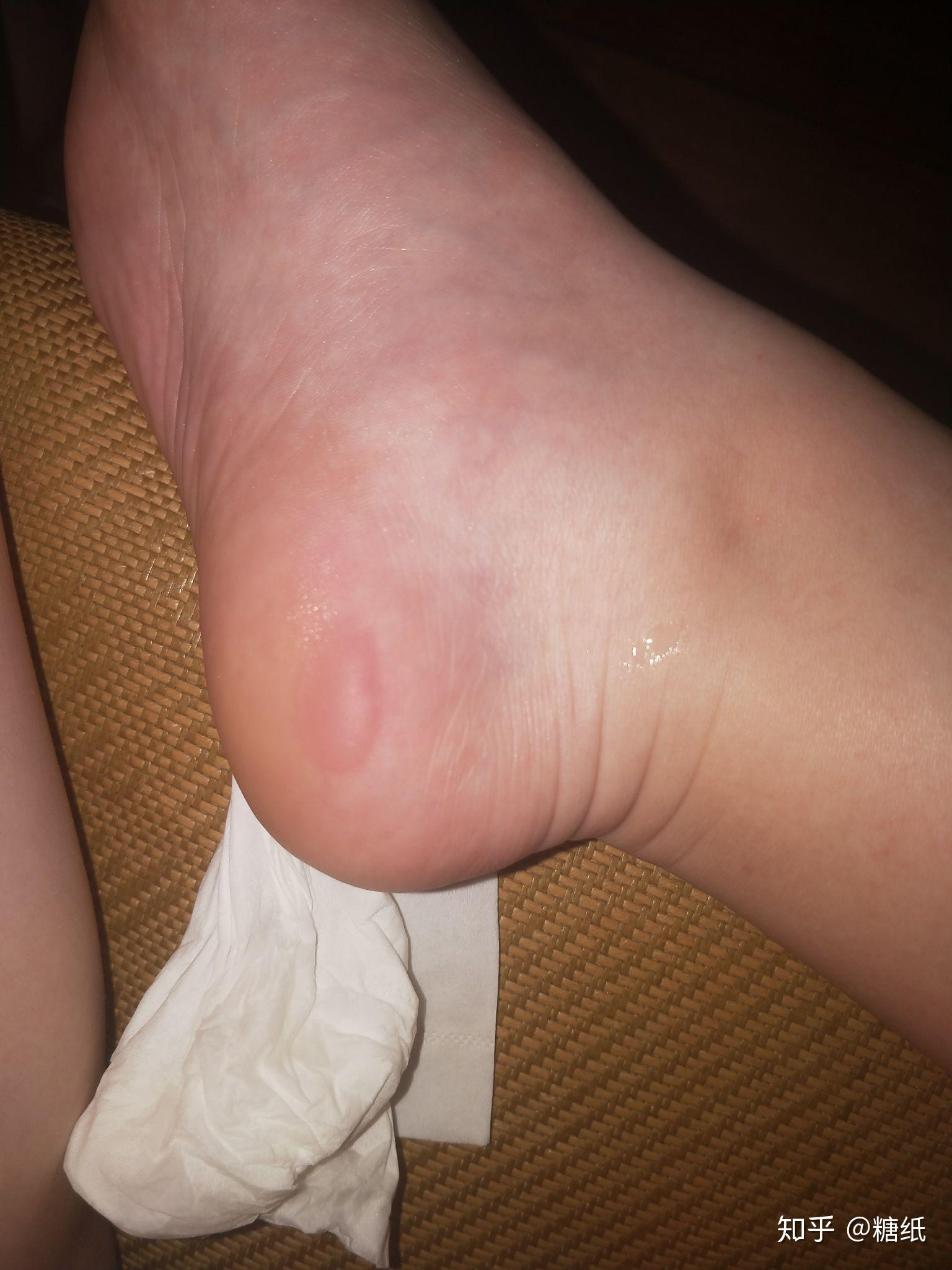 跑步时脚上被鞋磨出了拇指甲那么大的水泡,要不要挤破? 