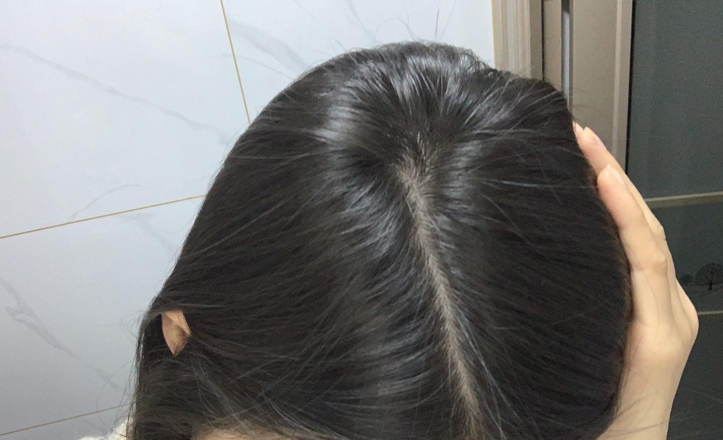 头发出油导致的严重脱发,该怎么样进行洗护?