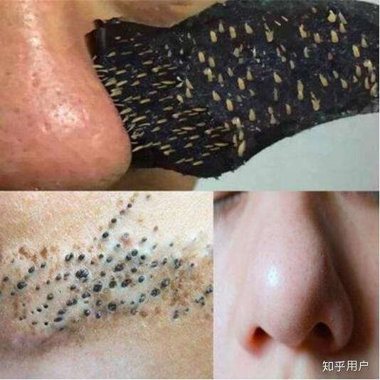 严重成这样的草莓鼻怎么办啊!求救啊! - 知乎