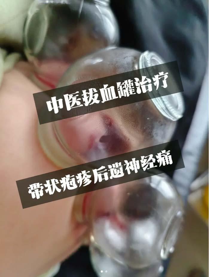 缠腰丹最快速治疗方法图片