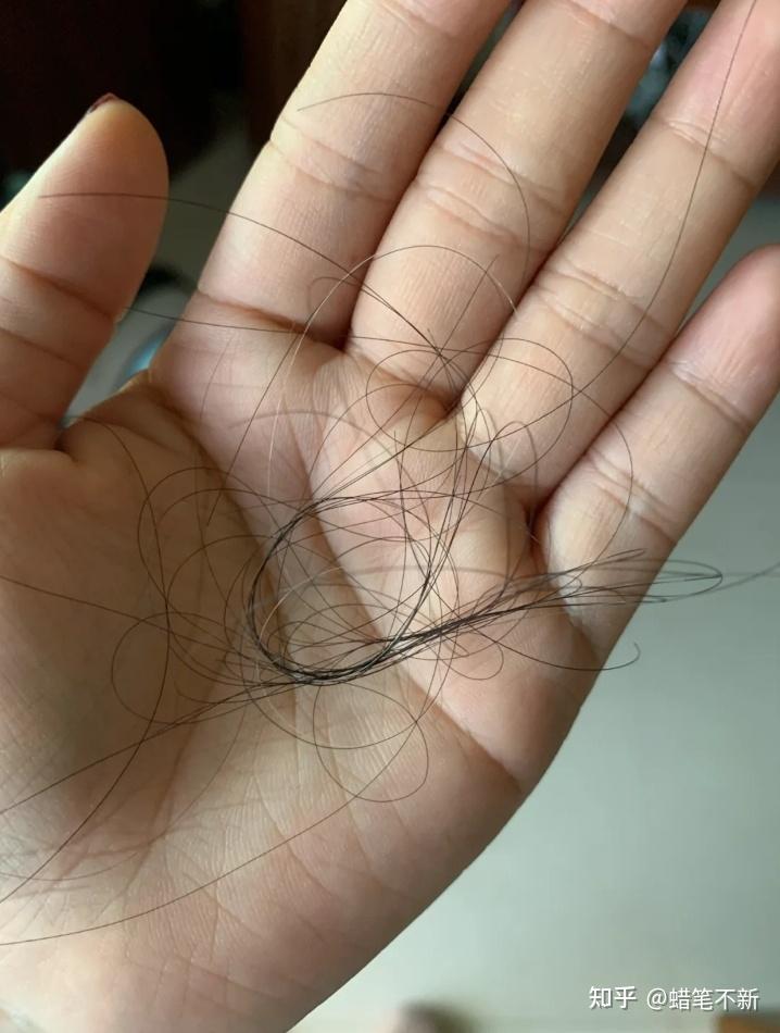 女生掉头发特别厉害该怎么解决