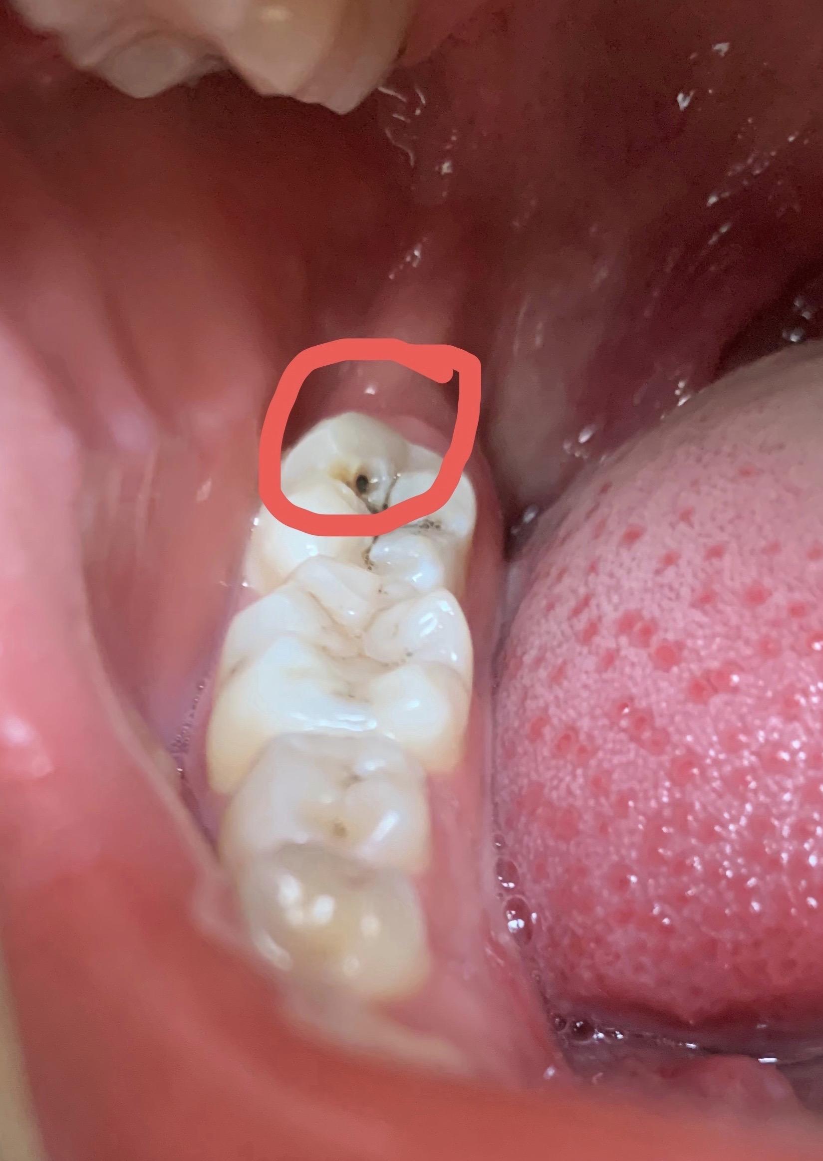 为什么大部分人会长智齿而有些人不长智齿?长智齿有何利弊? - 知乎