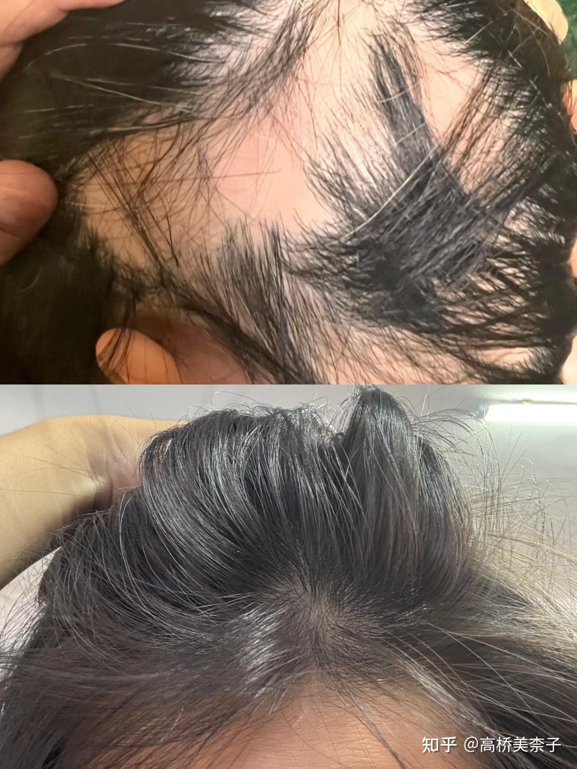 发缝变宽了,有没有比较好的育发液??? - 知乎