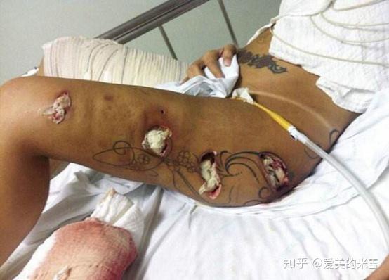 想做大腿吸脂手术,有什么建议?