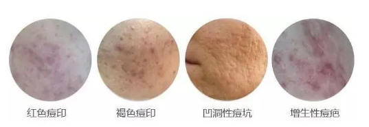 科普|为什么痘痘会在同一位置反复长? - 知乎