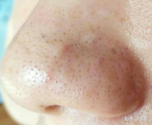 如何区分自己的黑头是螨虫型黑头还是脂栓型黑头?