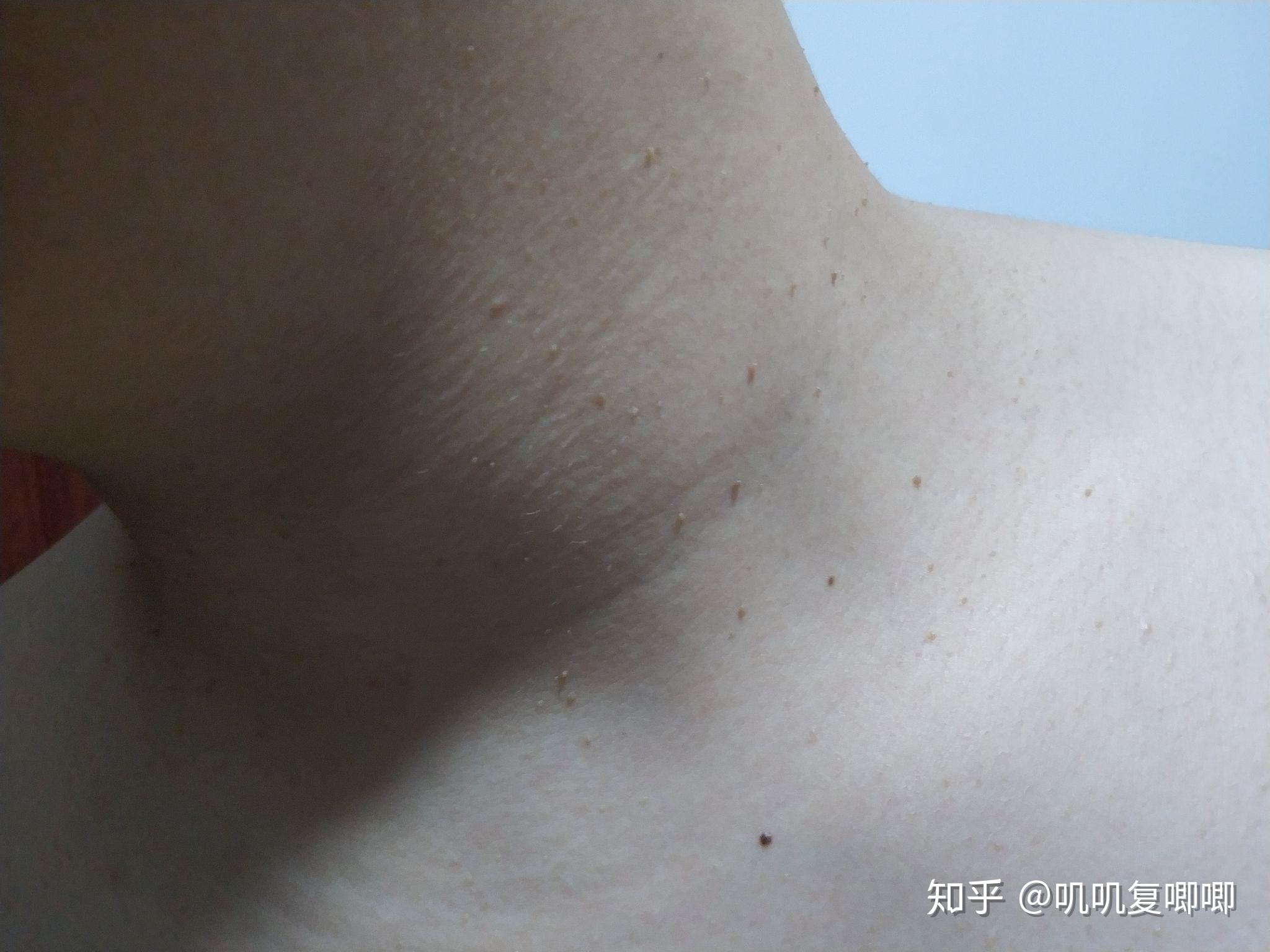 丝状疣脖子上女性医生说要激光扫有别的办法吗