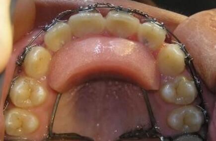 深覆颌深覆盖矫正固定平导