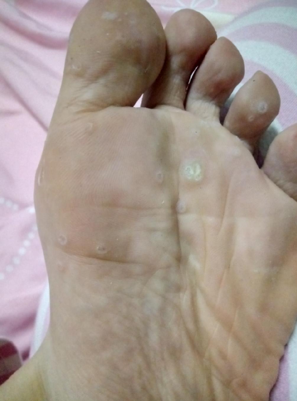 这是鸡眼吗最大那个中间凸起呈丝状一根根刺那种旁边有多个小的怎么治