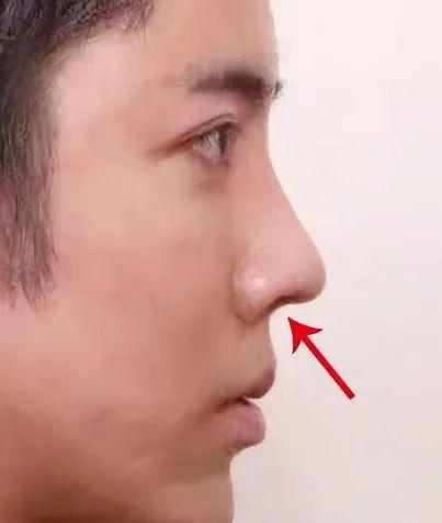 鼻小柱内凹是什么