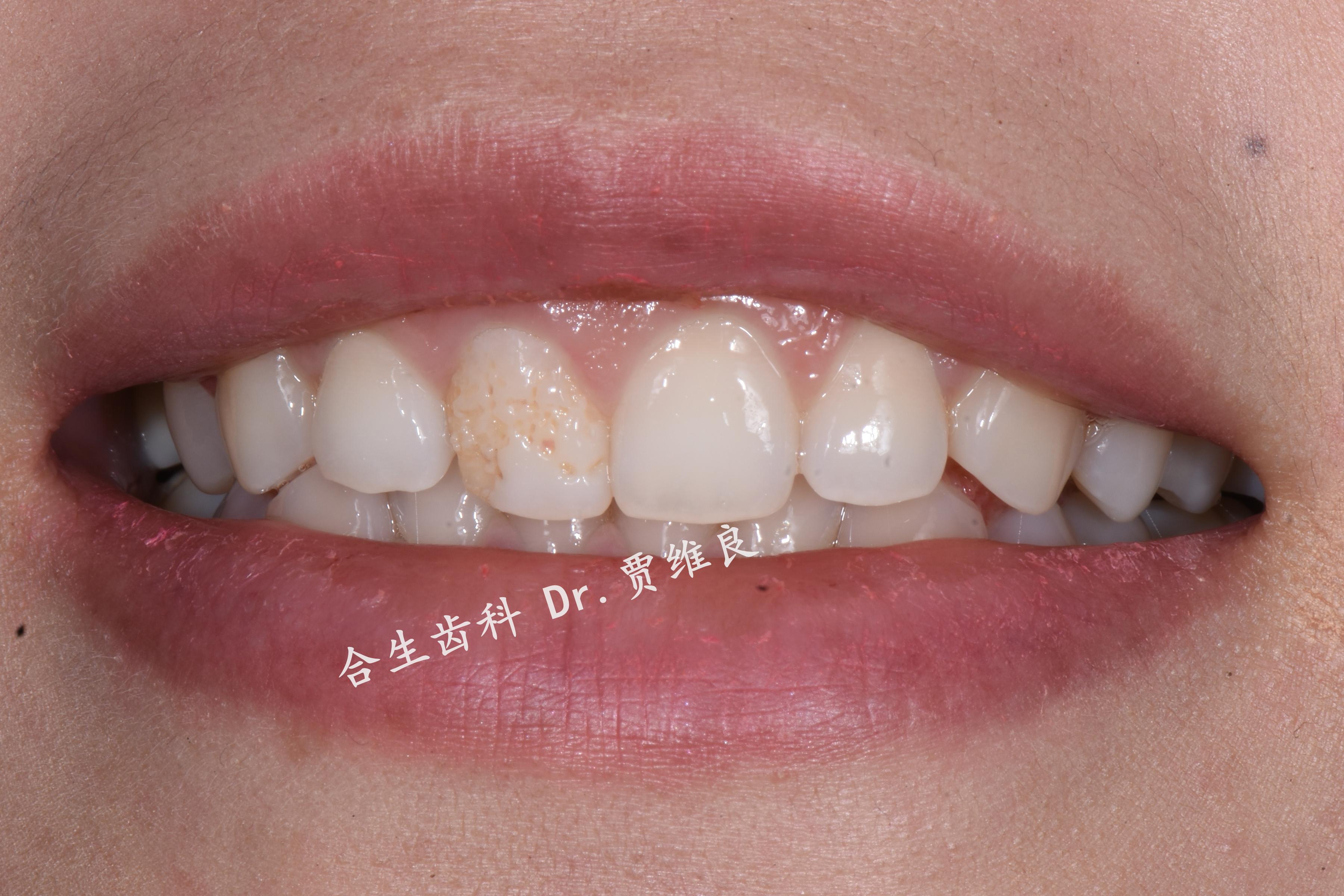 全瓷牙门牙做一颗是无法和旁边的牙颜色一致的么? - 知乎