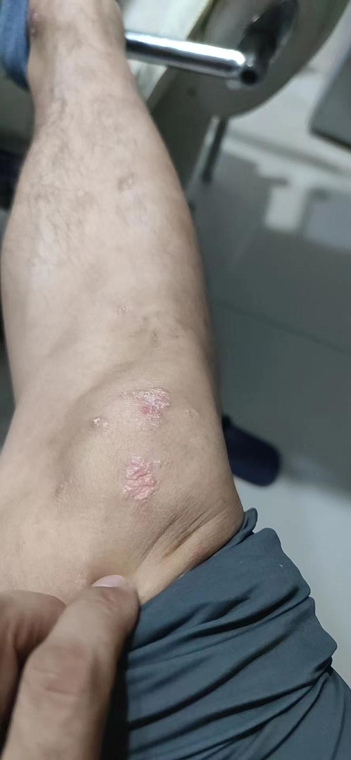 治疗银屑病过程中红斑变大是病情加重吗?