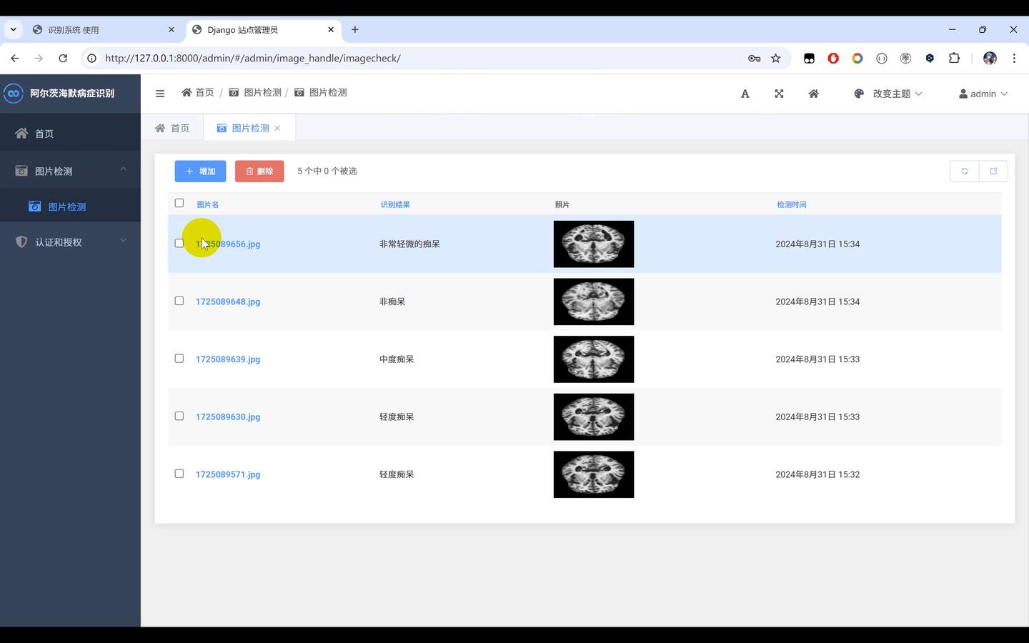 阿尔茨海默病症识别+图像识别Python+人工智能+深度学习+TensorFlow+机器学习+卷积神经网络算法 - 知乎