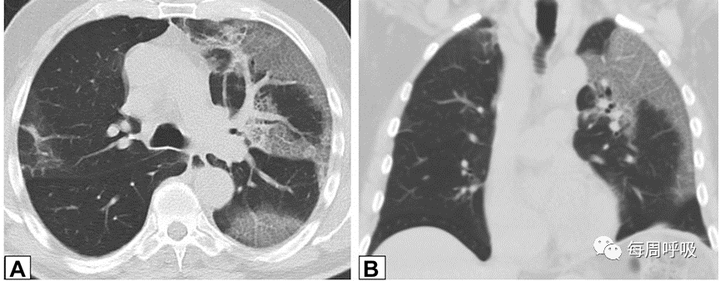 图片[8]-CHEST综述：机化性肺炎的诊断流程（临床-影像-病理特征相关性） | 每周呼吸-每周呼吸