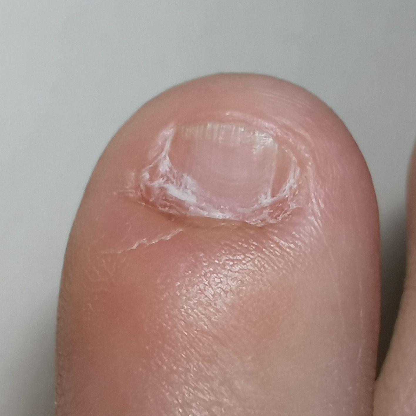 瓣状甲拔了还会长出来吗